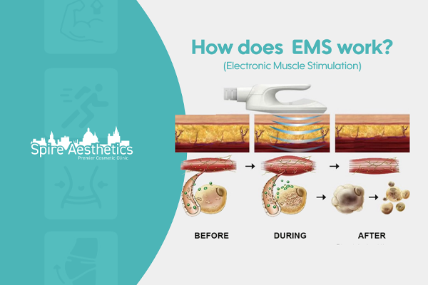 EMS treatment for post pregnancy weight loss treatment Cardonald