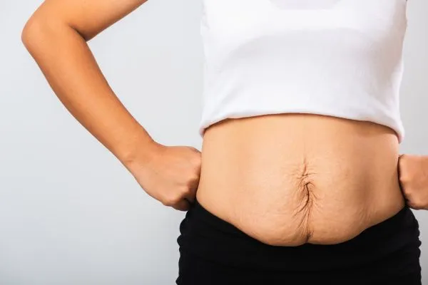 Image of a woman's stomach after weight loss with sagging skin following a gastric band Cardonald
